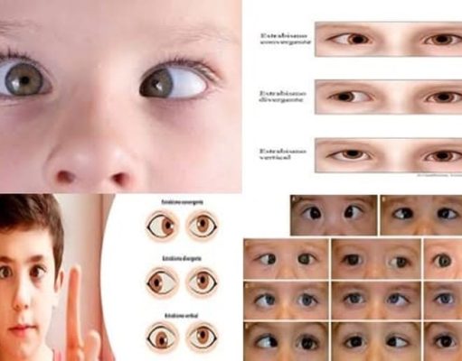 Aumento de casos de estrabismo infantil por el uso excesivo de dispositivos digitales post pandemia por COVID-19 y su intervención fisioterapéutica en México.